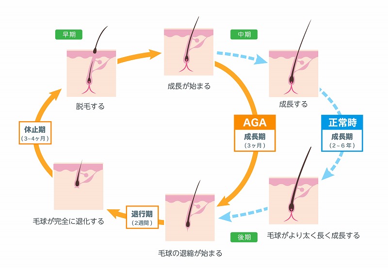 AGAの解説図