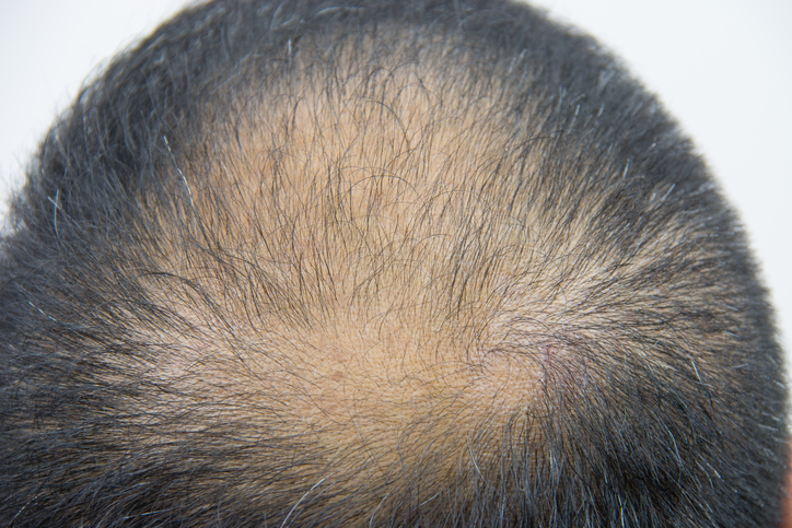 一般に薄毛の人は頭皮が肌色になってゆくが、これは紫外線による日焼け